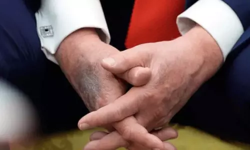 Trump के हाथ पर रहस्यमयी चोट के निशान की वायरल तस्वीर से स्वास्थ्य संबंधी अटकलें तेज़ हो गई