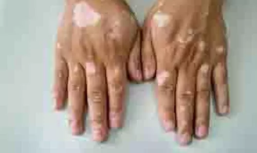 White Spots: त्वचा पर सफेद दाग क्यों होते हैं, क्या यह कोई बीमारी है White Spots: त्वचा पर सफेद दाग क्यों होते हैं, क्या यह कोई बीमारी है
