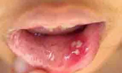 Mouth Ulcers: मुंह में छालों से हो गए हैं परेशान, तुरंत आजमाएं 5 घरेलू नुस्खे Mouth Ulcers: मुंह में छालों से हो गए हैं परेशान, तुरंत आजमाएं 5 घरेलू नुस्खे