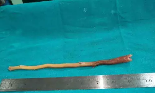 Berhampur डॉक्टरों ने भोजन नली से दांत का टुकड़ा निकाला