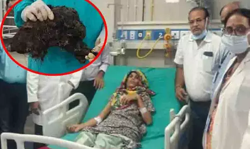 BREAKING: महिला के पेट से दूरबीन तकनीक से निकाला गया 6 किलो बालों का गुच्छा