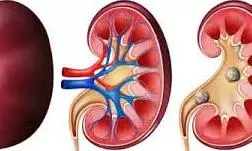 Health: पथरी से छुटकारा पाने के लिए अपनाएं आचार्य बालकृष्ण के ये उपाय Health: पथरी से छुटकारा पाने के लिए अपनाएं आचार्य बालकृष्ण के ये उपाय
