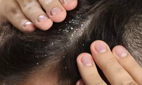 बालों से रूसी हटाने के प्राकृतिक तरीके बालों से रूसी हटाने के प्राकृतिक तरीके