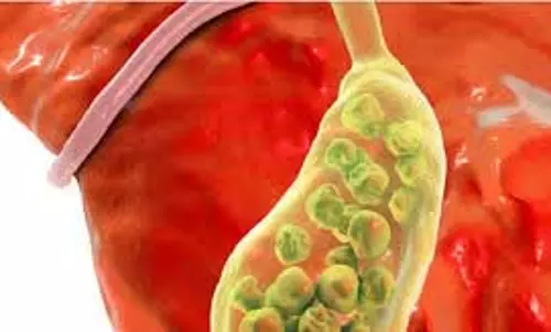Gallbladder Stones :इन कारणों से बढ़ जाता है गॉलब्लैडर में स्टोन का खतरा