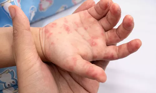 हैंड-फुट-माउथ Disease: बच्चों से बड़ों तक फैल रहा संक्रमण, जानें लक्षण और बचाव हैंड-फुट-माउथ Disease: बच्चों से बड़ों तक फैल रहा संक्रमण, जानें लक्षण और बचाव