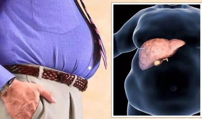 fatty liver से पीड़ित लोगों में क्या लक्षण दिखाई देते हैं? कौन से खाद्य पदार्थ खाने चाहिए? fatty liver से पीड़ित लोगों में क्या लक्षण दिखाई देते हैं? कौन से खाद्य पदार्थ खाने चाहिए?