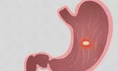 Stomach Ulcer: अल्सर क्यों होता है,जानिए इसके शुरुआती लक्षण Stomach Ulcer: अल्सर क्यों होता है,जानिए इसके शुरुआती लक्षण