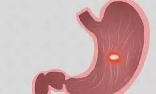 Stomach Ulcer: अल्सर क्यों होता है,जानिए इसके शुरुआती लक्षण Stomach Ulcer: अल्सर क्यों होता है,जानिए इसके शुरुआती लक्षण