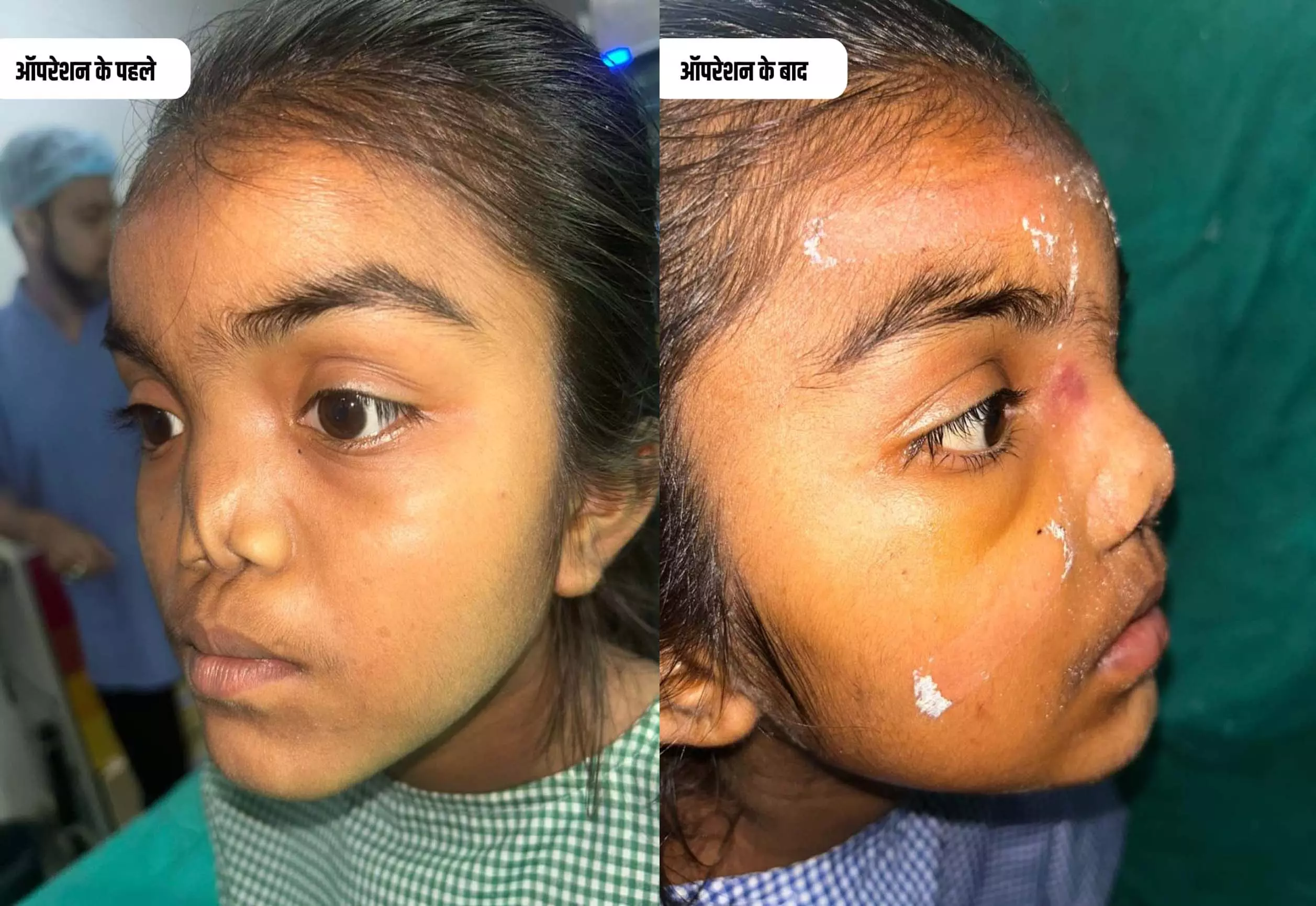 प्रोजेक्ट जिंदगी मुस्कुराएगी से लौटी बिटिया की मुस्कान, नाक की जन्मजात विकृति का हुआ सफल इलाज प्रोजेक्ट जिंदगी मुस्कुराएगी से लौटी बिटिया की मुस्कान, नाक की जन्मजात विकृति का हुआ सफल इलाज