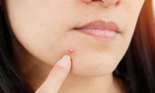 घरेलू उपचार से पिंपल की समस्या से कैसे छुटकारा पाएं