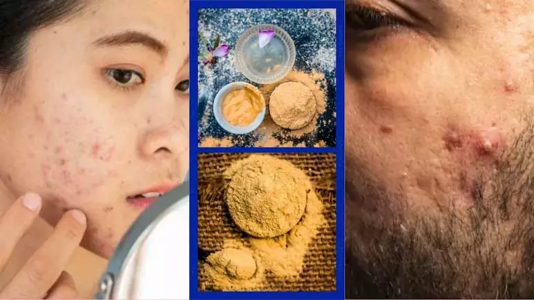 मुल्तानी मिट्टी लगाने से नहीं जाएगा हर मुंहासा, बिना डॉक्टर की सलाह के Skin पर एक्सपेरिमेंट पड़ सकता है भारी मुल्तानी मिट्टी लगाने से नहीं जाएगा हर मुंहासा, बिना डॉक्टर की सलाह के Skin पर एक्सपेरिमेंट पड़ सकता है भारी