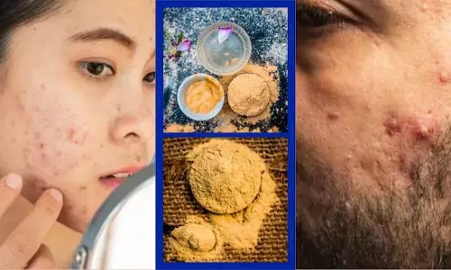 मुल्तानी मिट्टी लगाने से नहीं जाएगा हर मुंहासा, बिना डॉक्टर की सलाह के Skin पर एक्सपेरिमेंट पड़ सकता है भारी मुल्तानी मिट्टी लगाने से नहीं जाएगा हर मुंहासा, बिना डॉक्टर की सलाह के Skin पर एक्सपेरिमेंट पड़ सकता है भारी