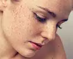 Dark Spot Removal: काले दाग-धब्बों को कहे अलविदा,ऐसे पाएं बेदाग और दमकती त्वचा Dark Spot Removal: काले दाग-धब्बों को कहे अलविदा,ऐसे पाएं बेदाग और दमकती त्वचा