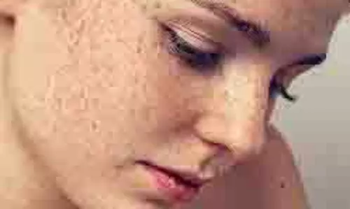 Dark Spot Removal: काले दाग-धब्बों को कहे अलविदा,ऐसे पाएं बेदाग और दमकती त्वचा