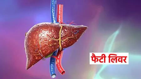 चुपचाप बढ़ने वाली गंभीर समस्या है फैटी लिवर, इन आयुर्वेदिक उपायों से मिलेगा छुटकारा चुपचाप बढ़ने वाली गंभीर समस्या है फैटी लिवर, इन आयुर्वेदिक उपायों से मिलेगा छुटकारा