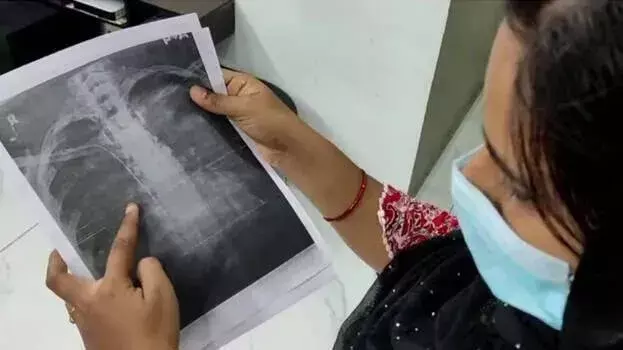 kerala: सर्जरी में महिला के सीने में गाइड वायर रह गया, मामले की जांच शुरू
