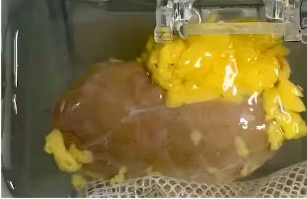 अब हर ब्लड ग्रुप के मरीज को मिलेगी Kidney, वैज्ञानिकों ने बनाई यूनिवर्सल किडनी अब हर ब्लड ग्रुप के मरीज को मिलेगी Kidney, वैज्ञानिकों ने बनाई यूनिवर्सल किडनी