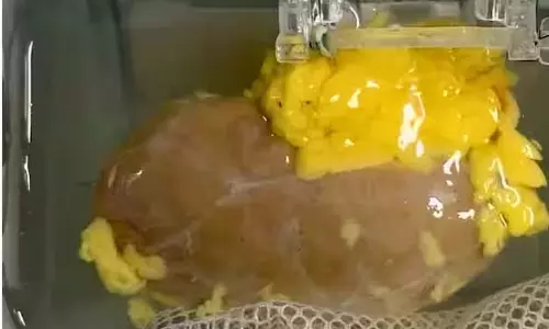 अब हर ब्लड ग्रुप के मरीज को मिलेगी Kidney, वैज्ञानिकों ने बनाई यूनिवर्सल किडनी अब हर ब्लड ग्रुप के मरीज को मिलेगी Kidney, वैज्ञानिकों ने बनाई यूनिवर्सल किडनी