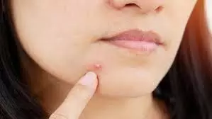 Skin Care: चेहरे पर निकल आएं मुंहासे, इन एंटीबैक्टीरियल पत्तियों का करें इस्तेमाल Skin Care: चेहरे पर निकल आएं मुंहासे, इन एंटीबैक्टीरियल पत्तियों का करें इस्तेमाल