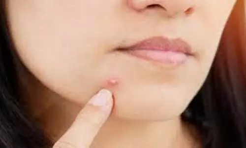 Skin Care: चेहरे पर निकल आएं मुंहासे, इन एंटीबैक्टीरियल पत्तियों का करें इस्तेमाल Skin Care: चेहरे पर निकल आएं मुंहासे, इन एंटीबैक्टीरियल पत्तियों का करें इस्तेमाल