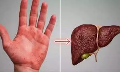 हाथों में दिखें ये 5 बदलाव, तो सावधान हो जाइए, Liver Damage का हो सकते हैं संकेत हाथों में दिखें ये 5 बदलाव, तो सावधान हो जाइए, Liver Damage का हो सकते हैं संकेत