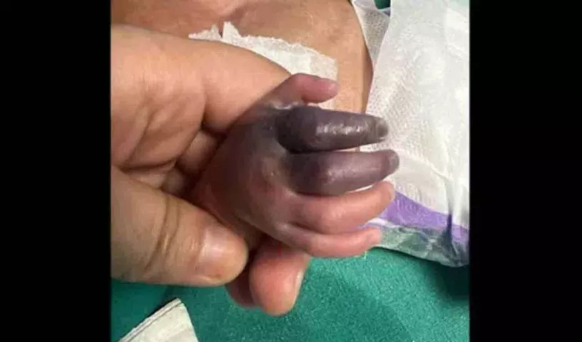 Nurse की गलती से नवजात का हाथ खतरे में Nurse की गलती से नवजात का हाथ खतरे में