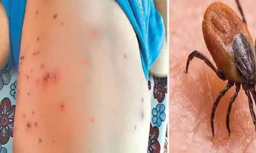 बड़गांव में दो बच्चे स्क्रब टाइफस से संक्रमित