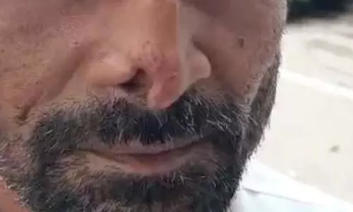 6 लोगों की नाक कटने के बाद सनसनी, DM तक पहुंचा मामला