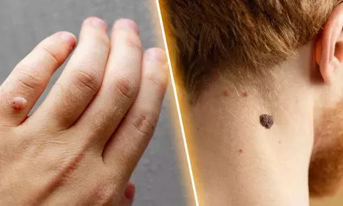 क्या आप बहुत ज़्यादा मस्सों से परेशान हैं? तो अपनाएँ ये प्राकृतिक नुस्खे