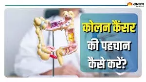 30 की उम्र से पहले भी हो सकता है Colon cancer, पहचानें ये 5 साइलेंट लक्षण 30 की उम्र से पहले भी हो सकता है Colon cancer, पहचानें ये 5 साइलेंट लक्षण