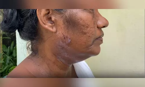 केरल में SIR अभ्यास के दौरान हादसा: कोट्टायम में बूथ लेवल अधिकारी पर कुत्ता छोड़ा गया, महिला घायल