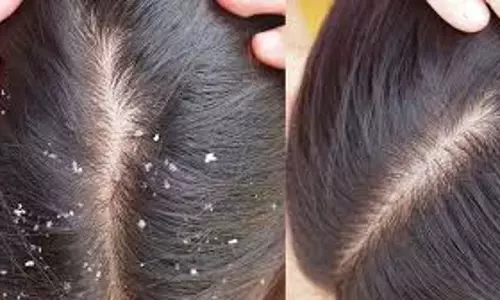 Hair Care: सर्दियों में प्राकृतिक रूप से रूसी पर नियंत्रण Hair Care: सर्दियों में प्राकृतिक रूप से रूसी पर नियंत्रण