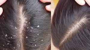 Hair Care: सर्दियों में प्राकृतिक रूप से रूसी पर नियंत्रण Hair Care: सर्दियों में प्राकृतिक रूप से रूसी पर नियंत्रण