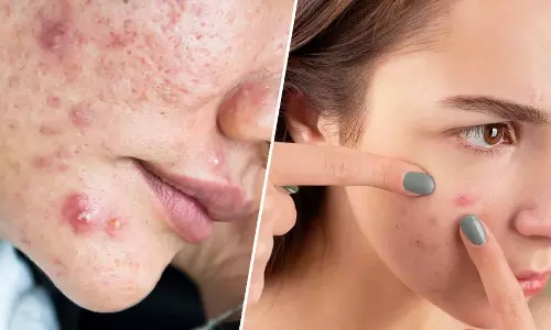 Skin Care: पिंपल्स और ऑयली स्किन से छुटकारा पाने के आसान और असरदार तरीके Skin Care: पिंपल्स और ऑयली स्किन से छुटकारा पाने के आसान और असरदार तरीके