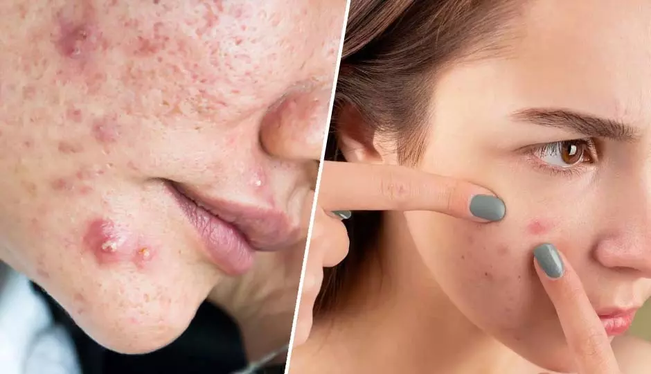 Skin Care: पिंपल्स और ऑयली स्किन से छुटकारा पाने के आसान और असरदार तरीके Skin Care: पिंपल्स और ऑयली स्किन से छुटकारा पाने के आसान और असरदार तरीके