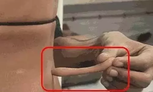 OMG! डेढ़ साल के बच्चे की पीठ से 14 सेमी पूंछ OMG! डेढ़ साल के बच्चे की पीठ से 14 सेमी पूंछ