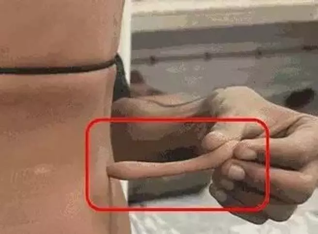 OMG! डेढ़ साल के बच्चे की पीठ से 14 सेमी पूंछ OMG! डेढ़ साल के बच्चे की पीठ से 14 सेमी पूंछ