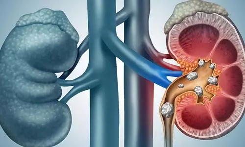 Kidney Stones : जानिए किडनी स्टोन के बारे में 7 हैरान करने वाले फैक्ट्स Kidney Stones : जानिए किडनी स्टोन के बारे में 7 हैरान करने वाले फैक्ट्स