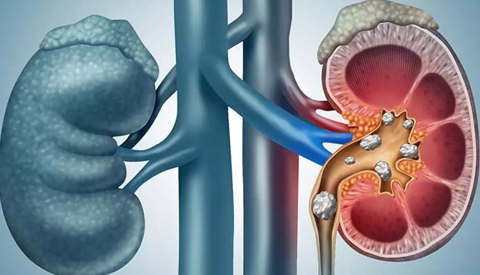 Kidney Stones : जानिए किडनी स्टोन के बारे में 7 हैरान करने वाले फैक्ट्स Kidney Stones : जानिए किडनी स्टोन के बारे में 7 हैरान करने वाले फैक्ट्स