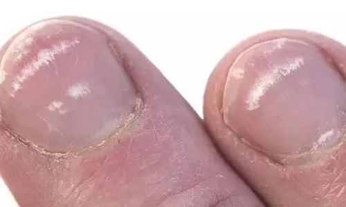 क्या आपके नाखूनों पर white spots हैं? लेकिन क्या आप जानते हैं कि क्या हो रहा है? क्या आपके नाखूनों पर white spots हैं? लेकिन क्या आप जानते हैं कि क्या हो रहा है?