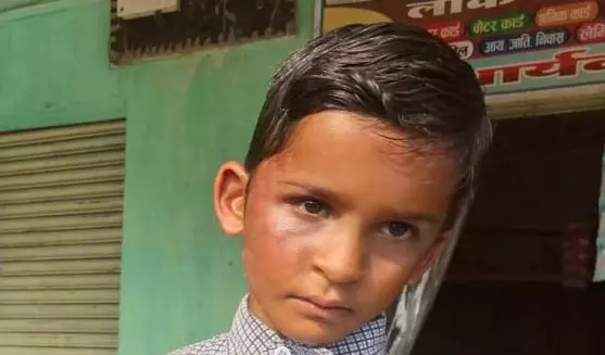 पहाड़ा नहीं पढ़ सका छात्र, शिक्षक की पिटाई से चेहरे में सूजन पहाड़ा नहीं पढ़ सका छात्र, शिक्षक की पिटाई से चेहरे में सूजन