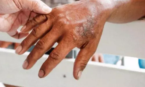 राज्य में Leprosy के 4,942 नए मामले सामने आए, सर्वे से पता चला राज्य में Leprosy के 4,942 नए मामले सामने आए, सर्वे से पता चला