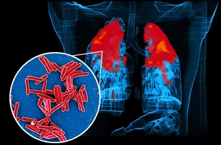 TB bacteria: अध्ययन से पता चला कैसे टीबी बैक्टीरिया एंटीबायोटिक दवाओं को देते हैं धोखा TB bacteria: अध्ययन से पता चला कैसे टीबी बैक्टीरिया एंटीबायोटिक दवाओं को देते हैं धोखा