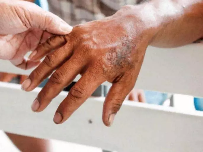 राज्य में Leprosy के 4,942 नए मामले सामने आए, सर्वे से पता चला राज्य में Leprosy के 4,942 नए मामले सामने आए, सर्वे से पता चला