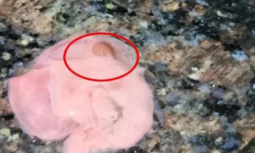 गर्भवती महिला के कैल्शियम सिरप में निकला मांस जैसा टुकड़ा गर्भवती महिला के कैल्शियम सिरप में निकला मांस जैसा टुकड़ा