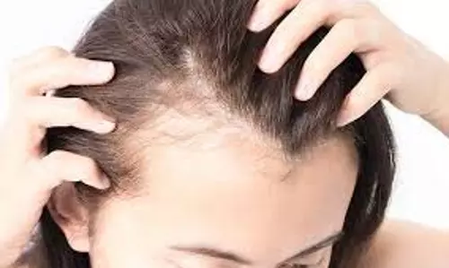 Hair Loss: गंजेपन से बचने का नेचुरल तरीका Hair Loss: गंजेपन से बचने का नेचुरल तरीका