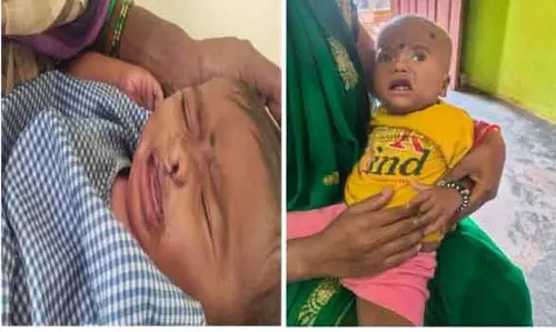 चिरायु योजना बच्चों के लिए भी बनी वरदान चिरायु योजना बच्चों के लिए भी बनी वरदान