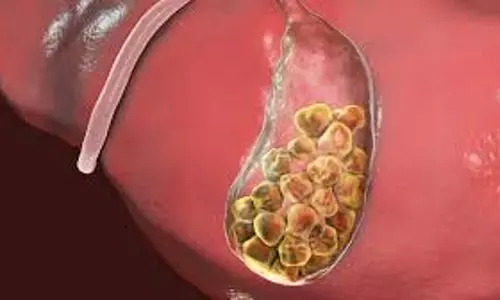 Health: गॉलब्लैडर स्टोन से हो सकती है मौत  , डॉक्टर ने बताया  लाइलाज