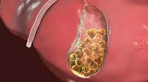Health: गॉलब्लैडर स्टोन से हो सकती है मौत , डॉक्टर ने बताया लाइलाज Health: गॉलब्लैडर स्टोन से हो सकती है मौत , डॉक्टर ने बताया लाइलाज