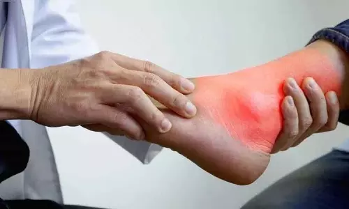 फल जो Uric Acid के स्तर को कम करने में मदद फल जो Uric Acid के स्तर को कम करने में मदद